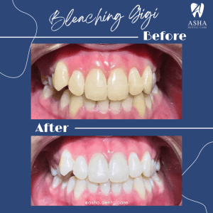 Bleaching Gigi Asha Dental Care 2