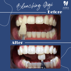 Bleaching Gigi Asha Dental Care