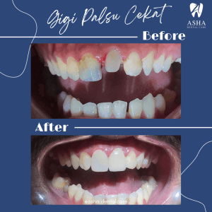 Gigi Palsu Cekat Asha Dental Care