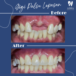 Gigi Palsu Lepasan Asha Dental Care