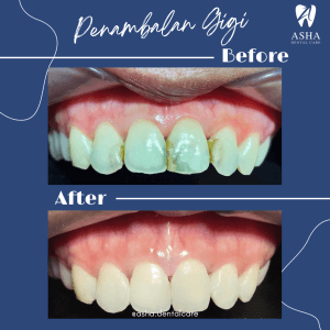 Penambalan Gigi Asha Dental Care 2
