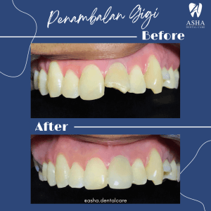Penambalan Gigi Asha Dental Care