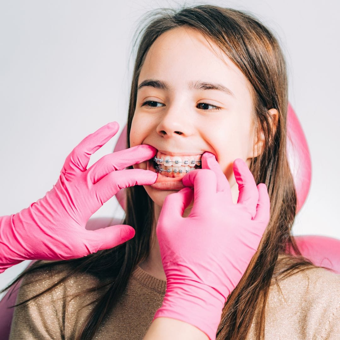 Pemasangan Behel Gigi, Wajib Ketahui Ini - Asha Dental Care