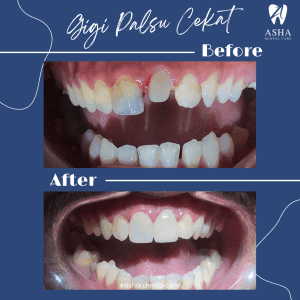 Gigi Palsu Cekat Asha Dental Care