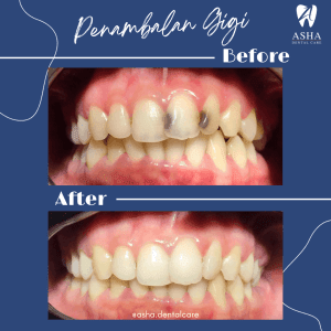 Penambalan Gigi Asha Dental Care 3
